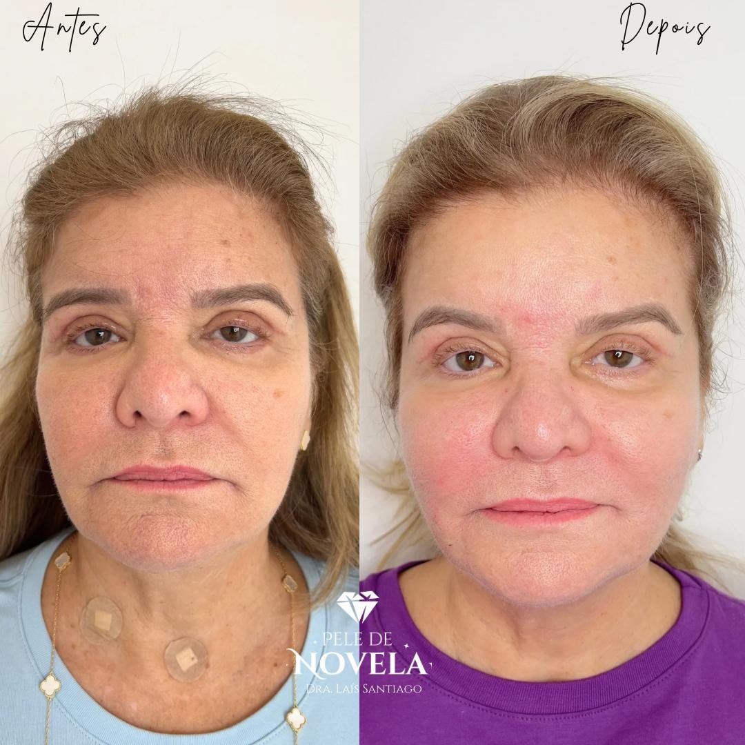 Antes e depois de paciente do Método Pele de Novela — rosto de frente
