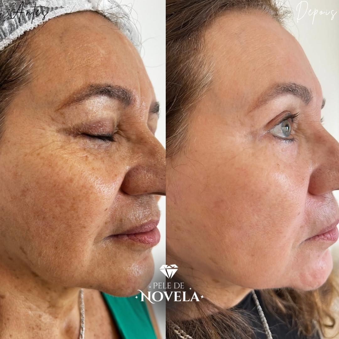 Antes e depois de paciente do Método Pele de Novela — rosto de perfil