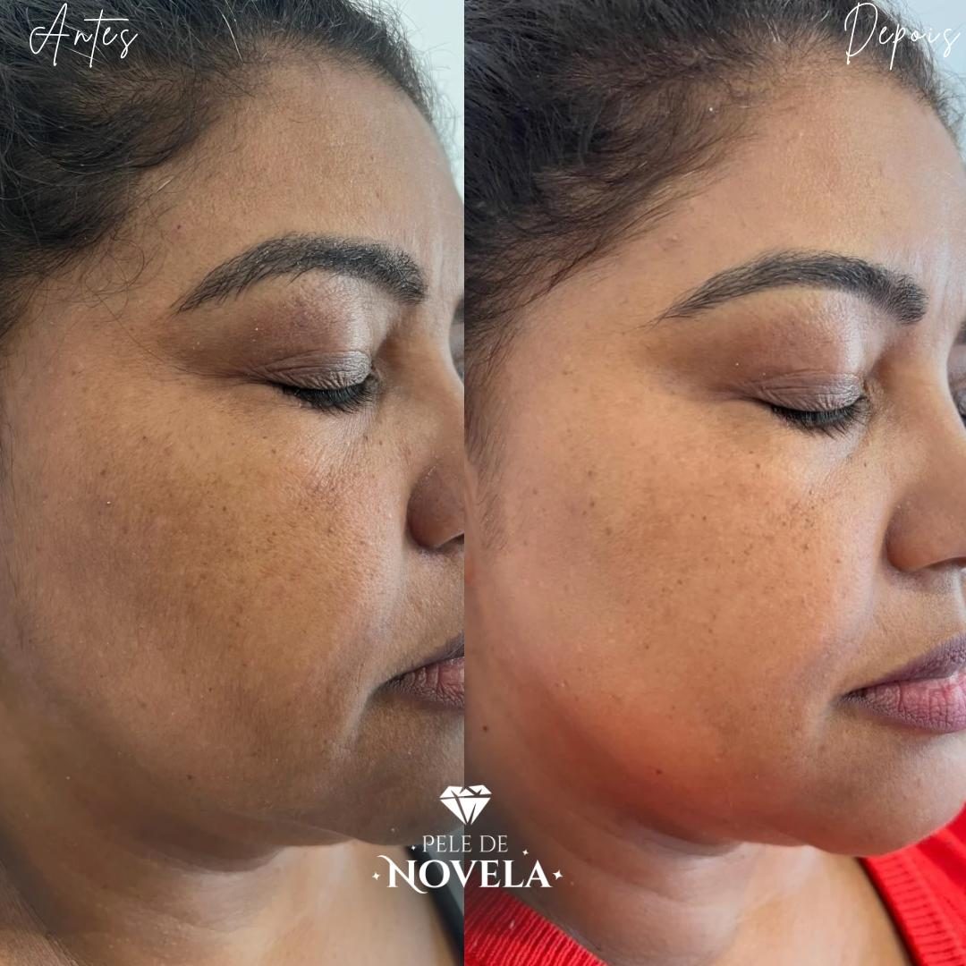 Antes e depois de paciente do Método Pele de Novela — rosto de perfil