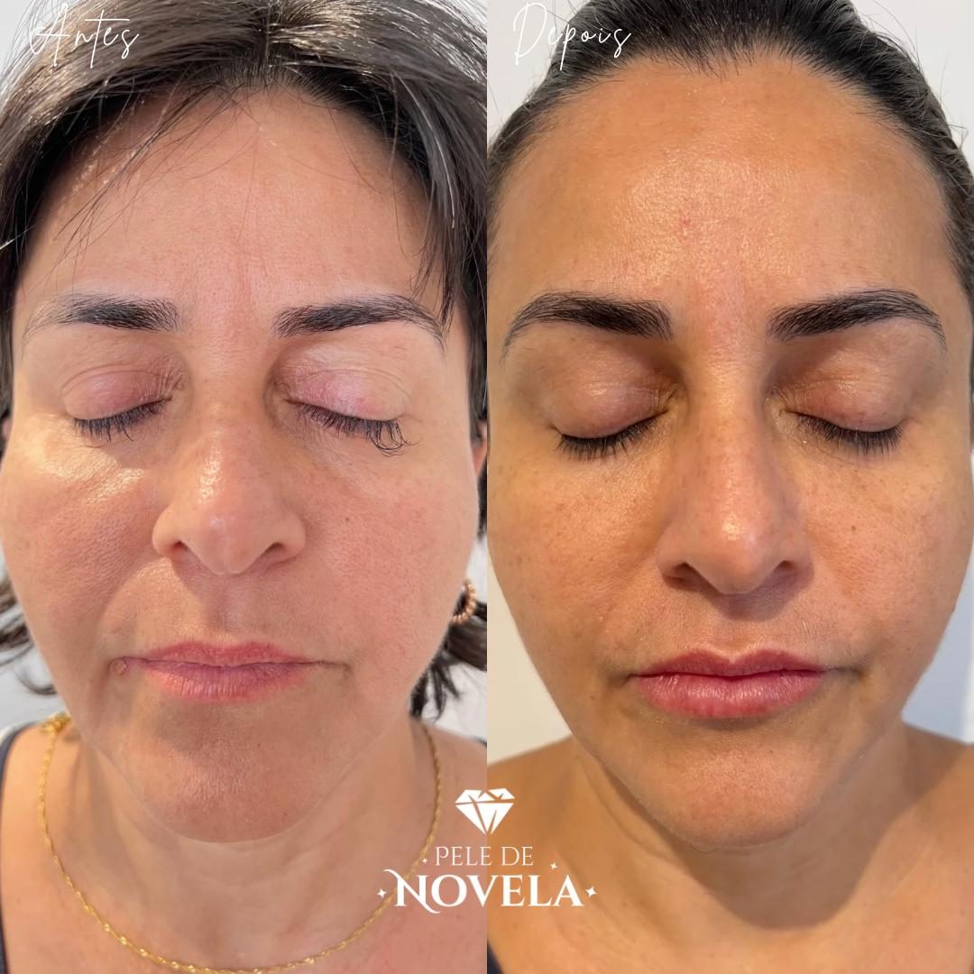 Antes e depois de paciente do Método Pele de Novela — olhos fechados