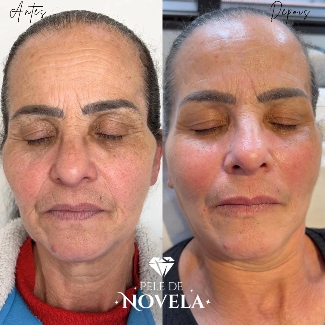 Antes e depois de paciente do Método Pele de Novela — rosto de frente