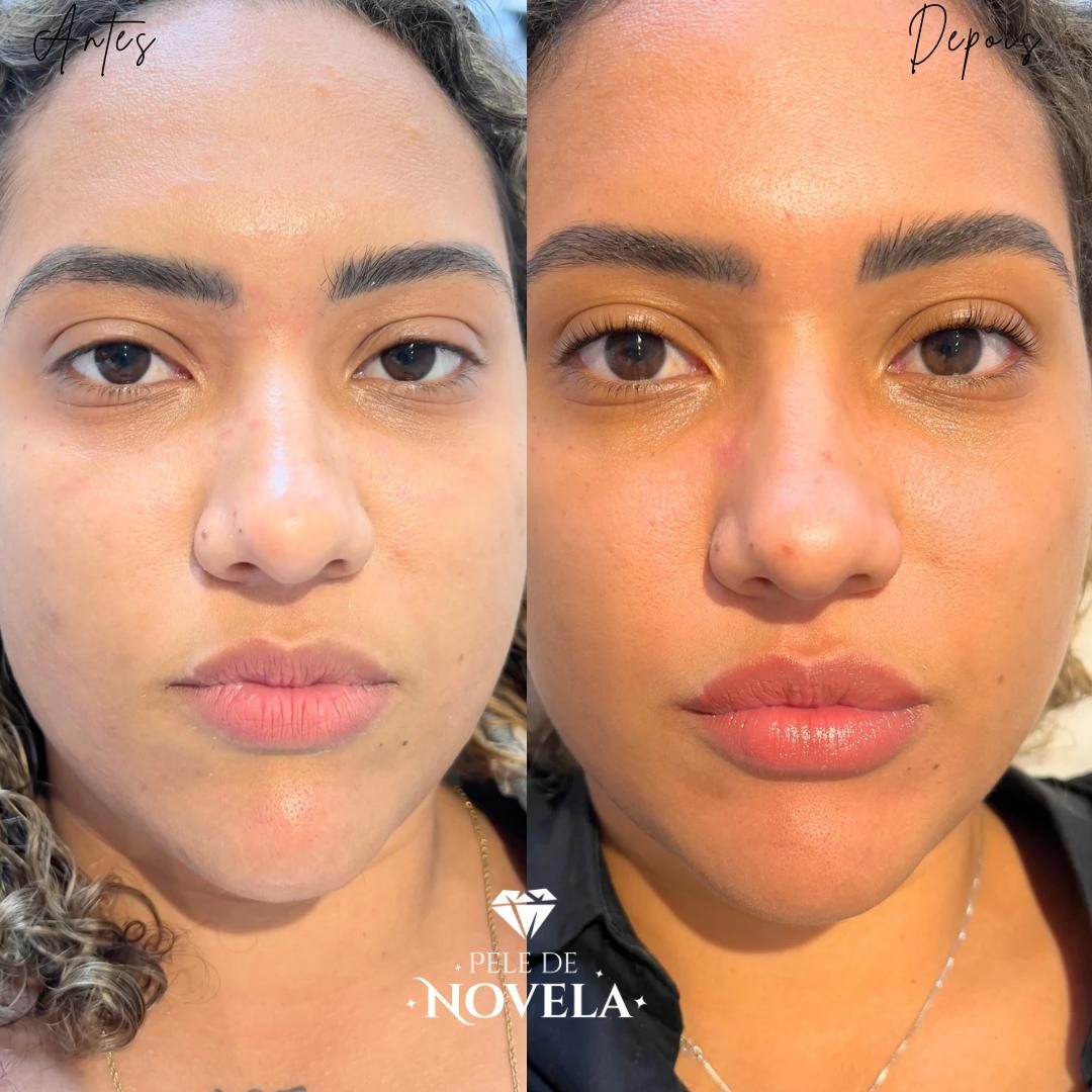 Antes e depois de paciente do Método Pele de Novela — rosto de frente